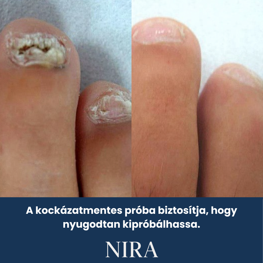 NIRA Éjszakai Tapasz Gombás Körömre (Természetes megoldás körömgombára)