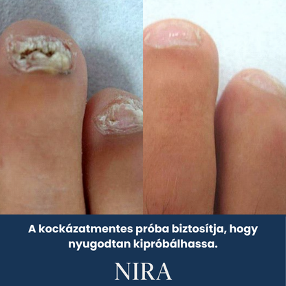 NIRA Éjszakai Tapasz Gombás Körömre (Természetes megoldás körömgombára)