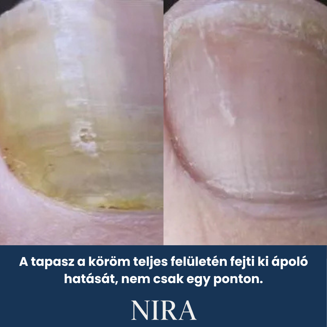 NIRA Éjszakai Tapasz Gombás Körömre (Természetes megoldás körömgombára)