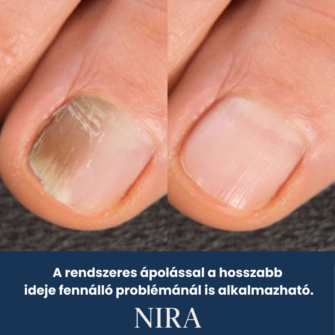 NIRA Éjszakai Tapasz Gombás Körömre (Természetes megoldás körömgombára)