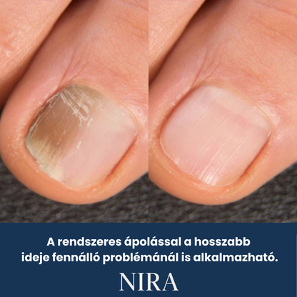 NIRA Éjszakai Tapasz Gombás Körömre (Természetes megoldás körömgombára)