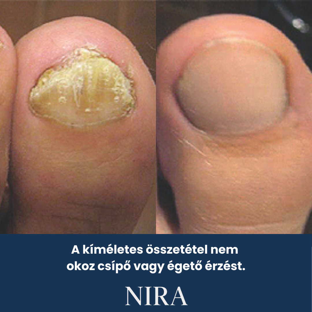 NIRA Éjszakai Tapasz Gombás Körömre (Természetes megoldás körömgombára)