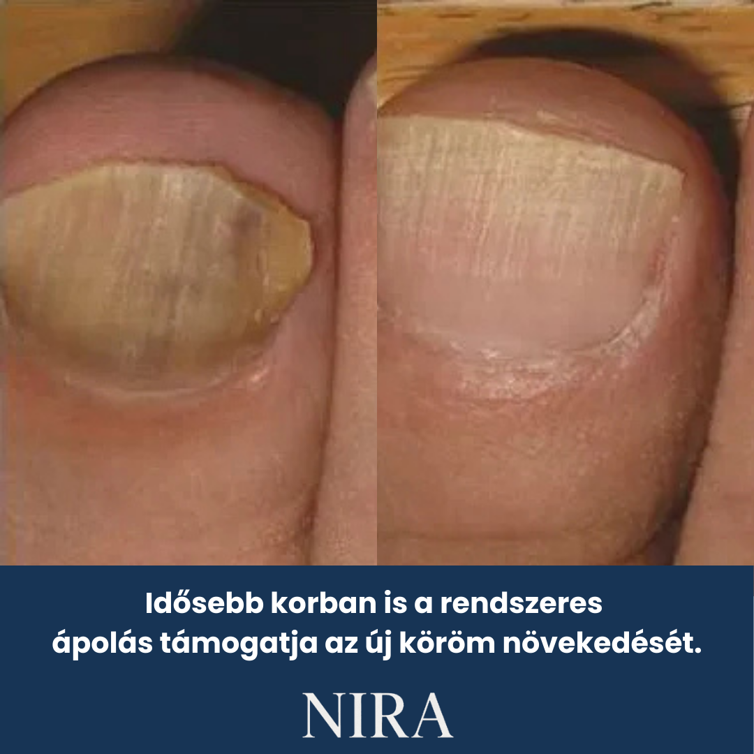 NIRA Éjszakai Tapasz Gombás Körömre (Természetes megoldás körömgombára)