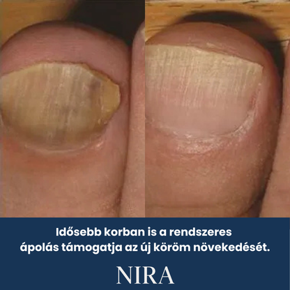 NIRA Éjszakai Tapasz Gombás Körömre (Természetes megoldás körömgombára)